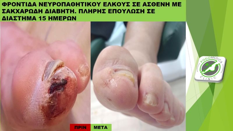 Ποδολόγος - Παλαιό Φάληρο - Podomedica Clinic- Διαβητικό πόδι - 5Ν