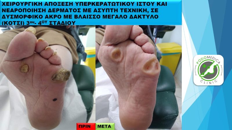 Ποδολόγος - Παλαιό Φάληρο - Podomedica Clinic - ΧΕΙΡΟΥΡΓΙΚΗ ΑΠΟΞΕΣΗ ΥΠΕΡΚΕΡΑΤΩΤΙΚΟΥ ΙΣΤΟΥ ΚΑΙ ΝΕΑΡΟΠΟΙΗΣΗ ΔΕΡΜΑΤΟΣ - 11Ν