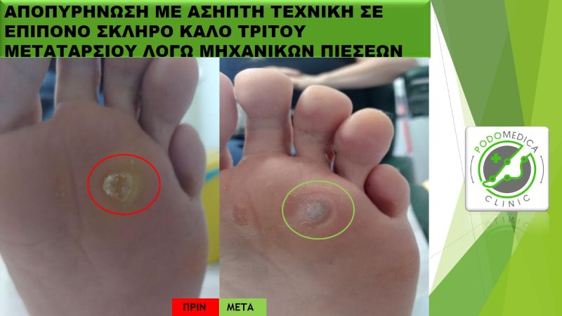 Ποδολόγος - Παλαιό Φάληρο - Podomedica Clinic
