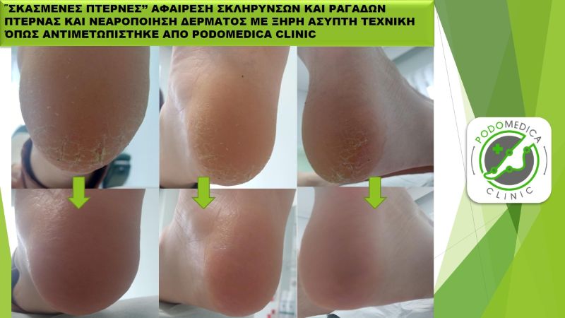 Ποδολόγος - Παλαιό Φάληρο - Podomedica Clinic