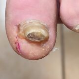 Ποδολόγος Άγιος Δημήτριος - Step Care