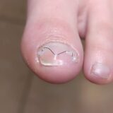 Ποδολόγος Άγιος Δημήτριος - Step Care