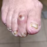 Ποδολόγος Άγιος Δημήτριος - Step Care