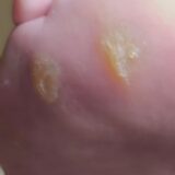 Ποδολόγος Άγιος Δημήτριος - Step Care